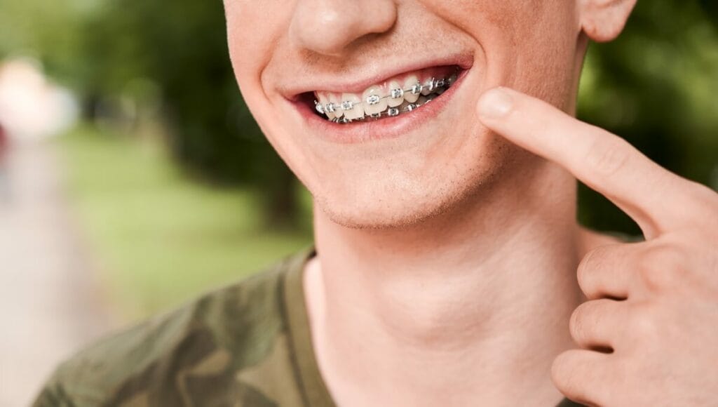 Przeciwwskazania do leczenia ortodontycznego - uśmiechnięty młody mężczyzna wskazujący na aparat ortodontyczny na swoich zębach