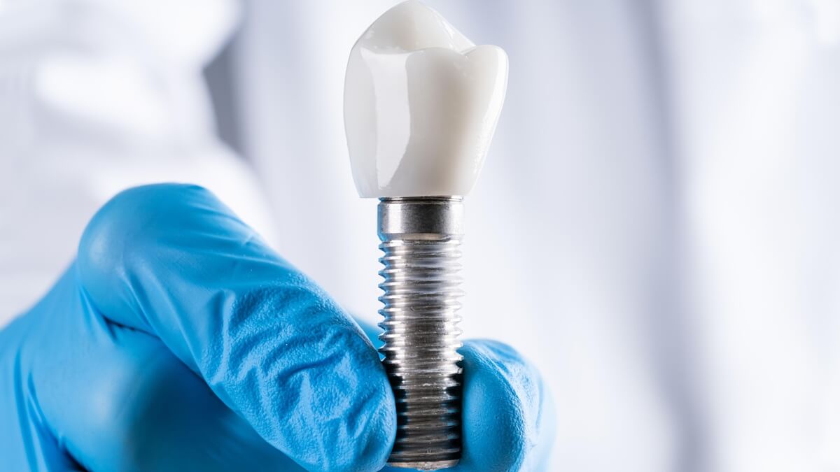 Implanty czy proteza - dentysta trzymający model implantu zęba