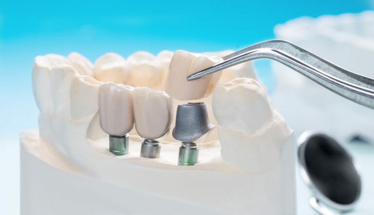 Czy implanty zębów są bezpieczne - model jamy ustnej z implantami zębowymi