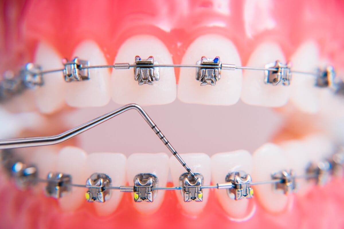 Leczenie wad zgryzu - aparat ortodontyczny na modelu zębów